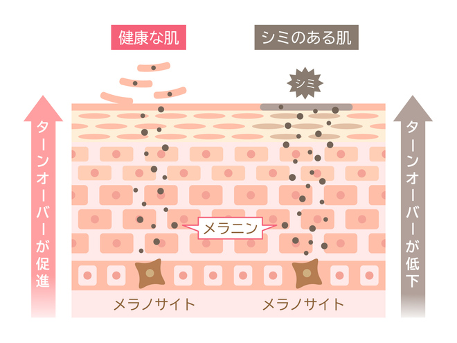 ターンオーバーの乱れによるメラニン毛穴