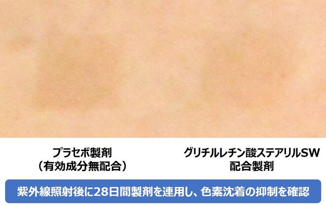 グリチルレチン酸ステアリルSW配合製剤を塗布