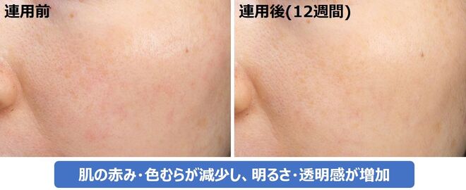 グリチルレチン酸ステアリルSW配合製剤の肌効果