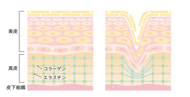 コラーゲンやエラスチンの生成量が減少