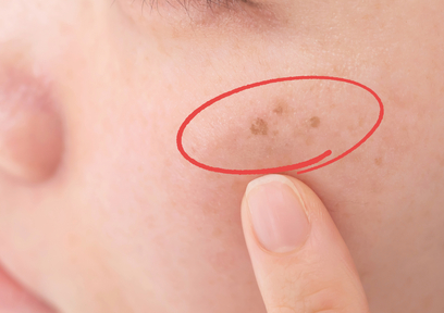 美白有効成分のはたらきとは？代表的な美白有効成分も紹介